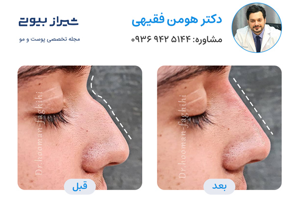 لیفت بینی در شیراز - دکتر هومن فقیهی