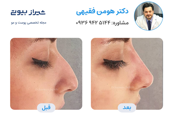لیفت بینی در شیراز - دکتر هومن فقیهی