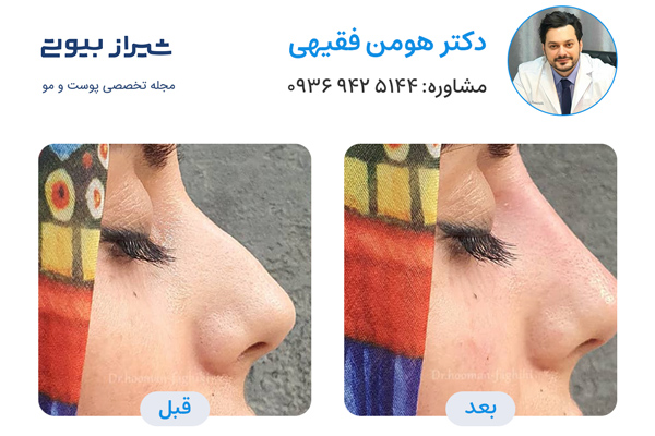 لیفت بینی در شیراز - دکتر هومن فقیهی