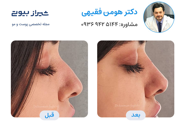 لیفت بینی در شیراز - دکتر هومن فقیهی