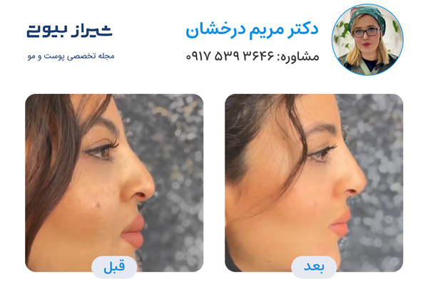 لیفت بینی در شیراز - دکتر مریم درخشان