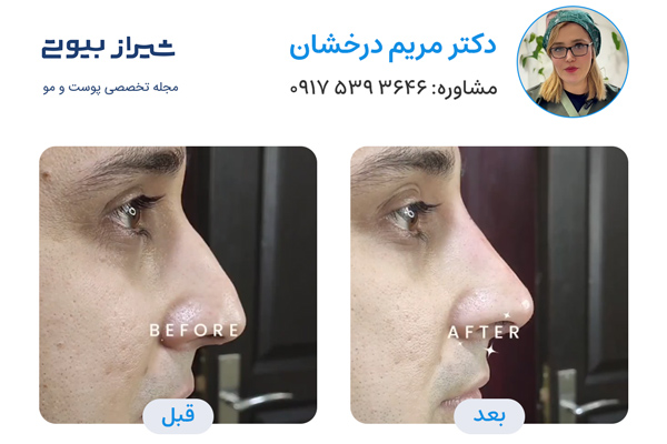 لیفت بینی در شیراز - دکتر مریم درخشان
