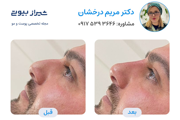 لیفت بینی در شیراز - دکتر مریم درخشان