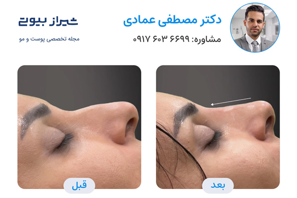 لیفت بینی در شیراز - دکتر مصطفی عمادی