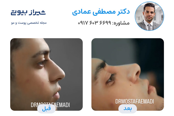 لیفت بینی در شیراز - دکتر مصطفی عمادی