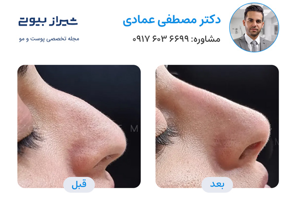 لیفت بینی در شیراز - دکتر مصطفی عمادی