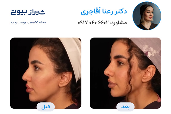 لیفت بینی در شیراز - دکتر رعنا آقاجری
