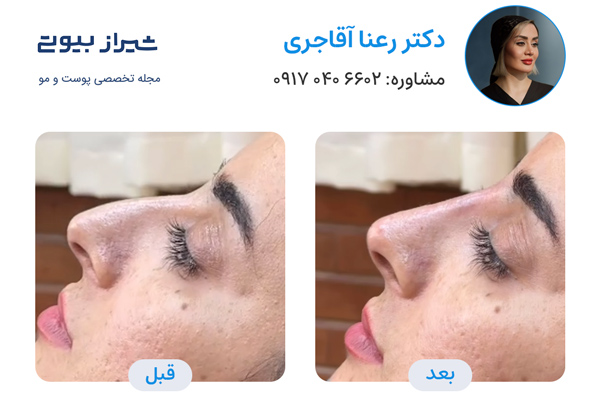 لیفت بینی در شیراز - دکتر رعنا آقاجری