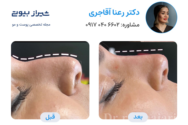 لیفت بینی در شیراز - دکتر رعنا آقاجری