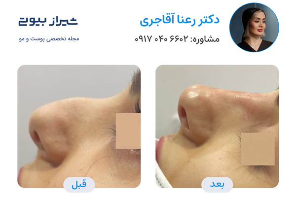 لیفت بینی در شیراز - دکتر رعنا آقاجری