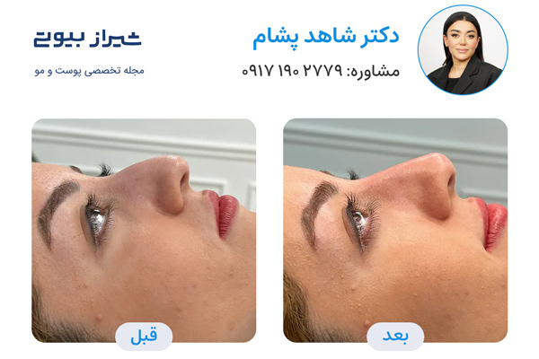 لیفت بینی در شیراز - دکتر شاهد پشام
