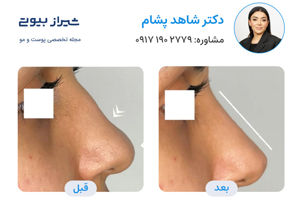 لیفت بینی در شیراز - دکتر شاهد پشام