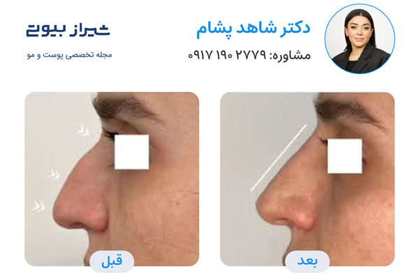لیفت بینی در شیراز - دکتر شاهد پشام