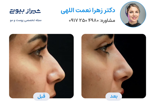 لیفت بینی در شیراز - دکتر زهرا نعمت اللهی