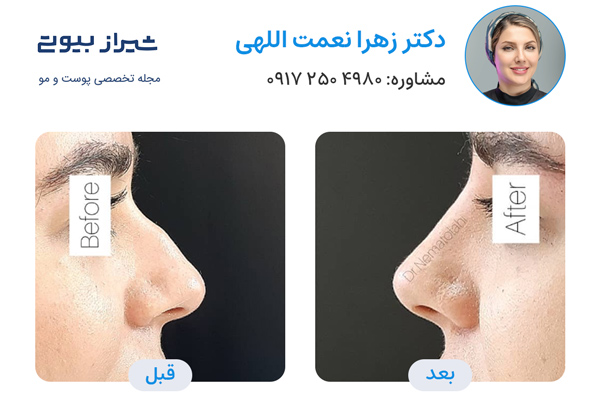 لیفت بینی در شیراز - دکتر زهرا نعمت اللهی