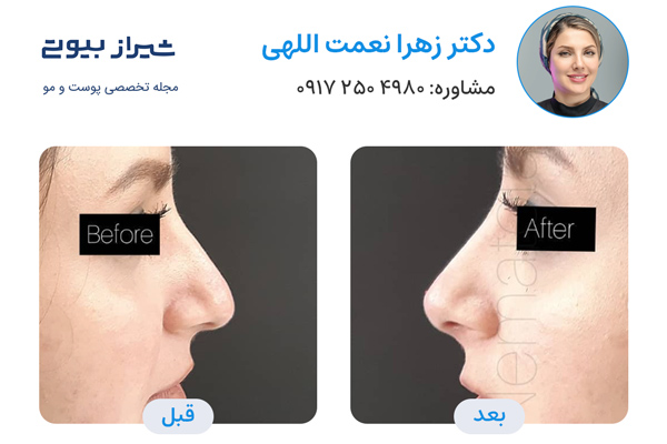 لیفت بینی در شیراز - دکتر زهرا نعمت اللهی