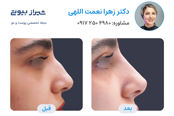 لیفت بینی در شیراز - دکتر زهرا نعمت اللهی