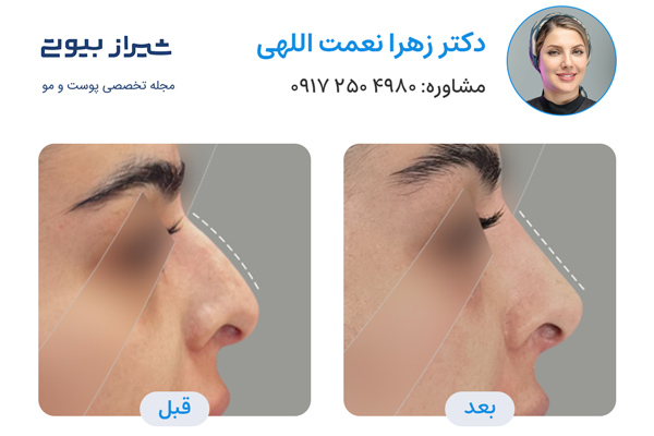 لیفت بینی در شیراز - دکتر زهرا نعمت اللهی