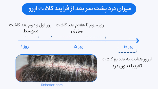 میزان درد پشت سر بعد از فرایند کاشت ابرو