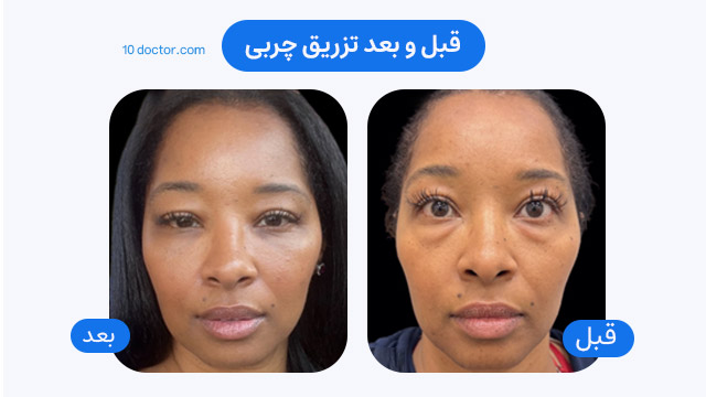 عکس قبل و بعد تزریق چربی