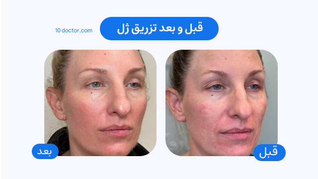 عکس قبل و بعد تزریق ژل 
