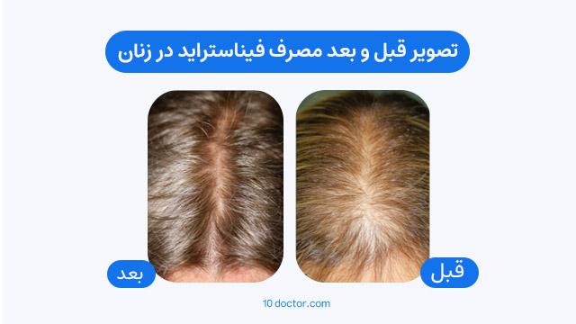 تصویر قبل و بعد مصرف فیناستراید در زنان