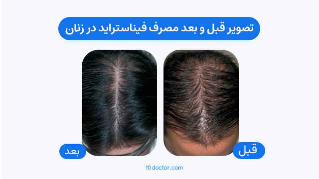 تصویر قبل و بعد مصرف فیناستراید در زنان