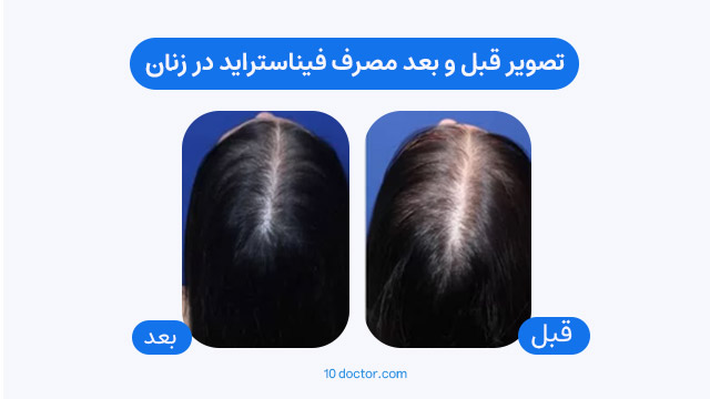 تصویر قبل و بعد مصرف فیناستراید در زنان