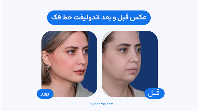 عکس قبل و بعد اندولیفت خط فک