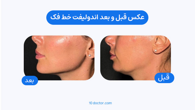عکس قبل و بعد اندولیفت خط فک