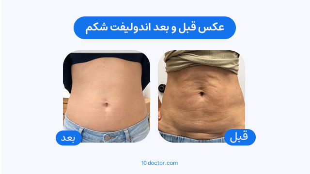 عکس قبل و بعد اندولیفت شکم