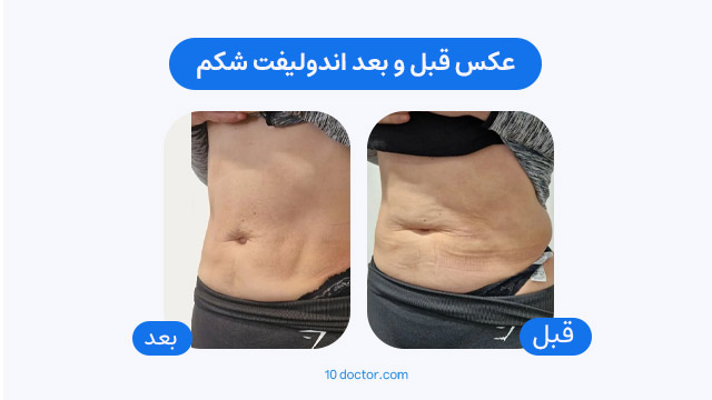 عکس قبل و بعد اندولیفت شکم