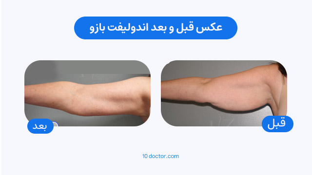 عکس قبل و بعد اندولیفت بازو