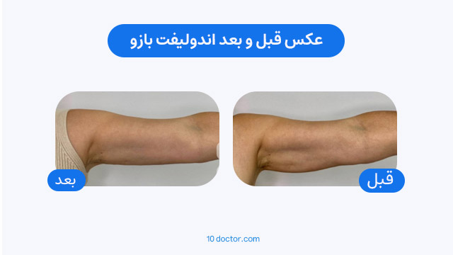 عکس قبل و بعد اندولیفت بازو