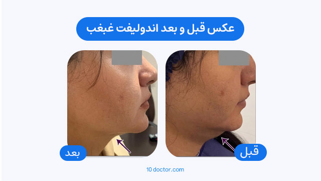 عکس قبل و بعد اندولیفت غبغب
