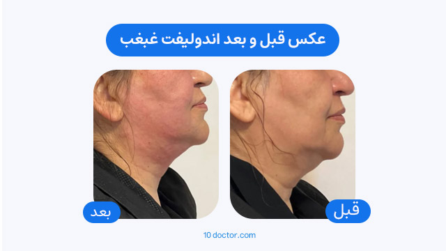 عکس قبل و بعد اندولیفت غبغب