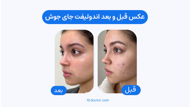 عکس قبل و بعد اندولیفت جای جوش