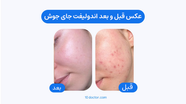 عکس قبل و بعد اندولیفت جای جوش