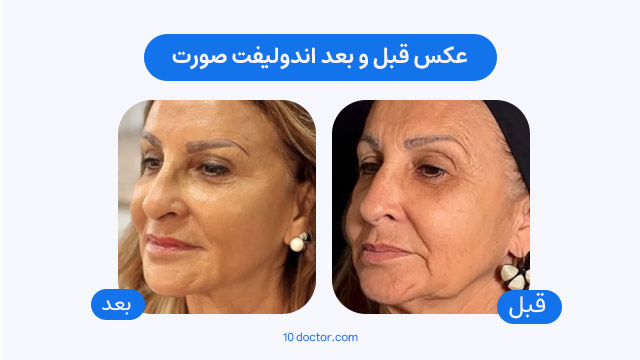 عکس قبل و بعد اندولیفت صورت