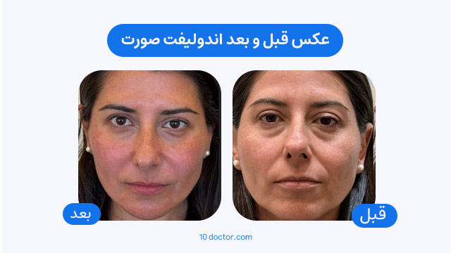 عکس قبل و بعد اندولیفت صورت
