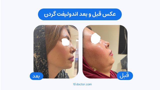 عکس قبل و بعد اندولیفت گردن