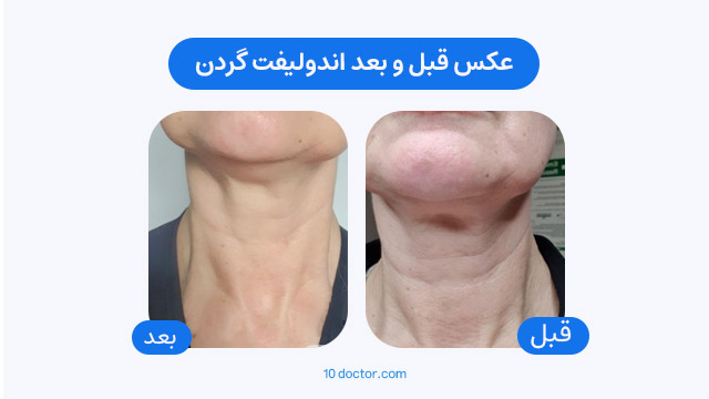 عکس قبل و بعد اندولیفت گردن