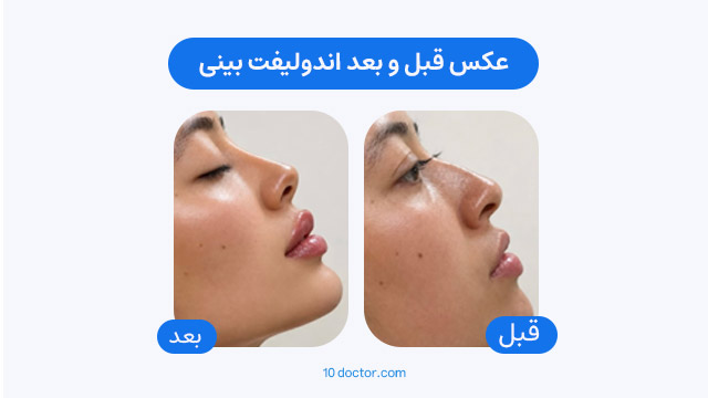 عکس قبل و بعد اندولیفت بینی