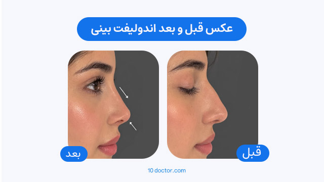 عکس قبل و بعد اندولیفت بینی
