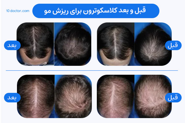 تصاویر قبل و بعد Clascotron برای ریزش مو