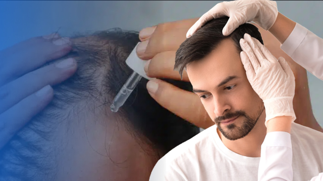 کلاسکوترون برای ریزش مو