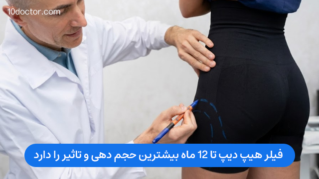 فیلر هیپ دیپ تا 12 ماه بیشترین حجم دهی و تاثیر را دارد. 