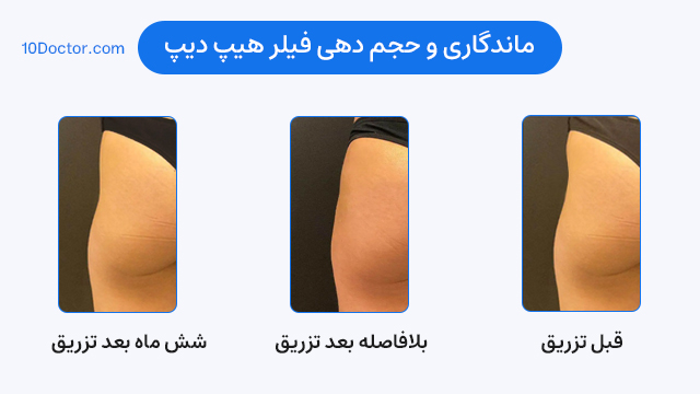 ماندگاری و حجم دهی فیلر هیپ دیپ - عکس قبل و بعد