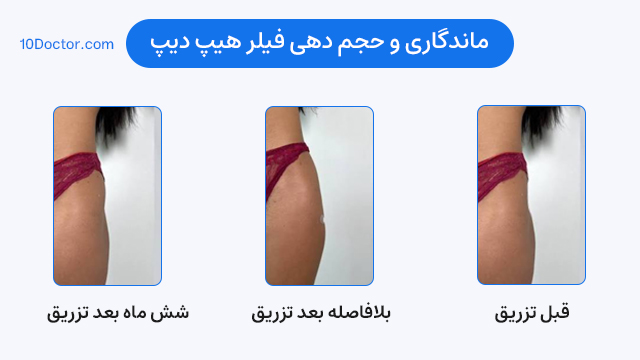 ماندگاری و حجم دهی فیلر هیپ دیپ - عکس قبل و بعد