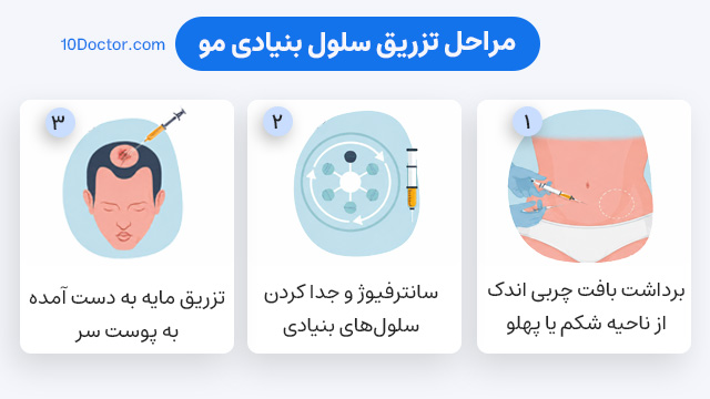 مراحل تزریق سلول بنیادی مو